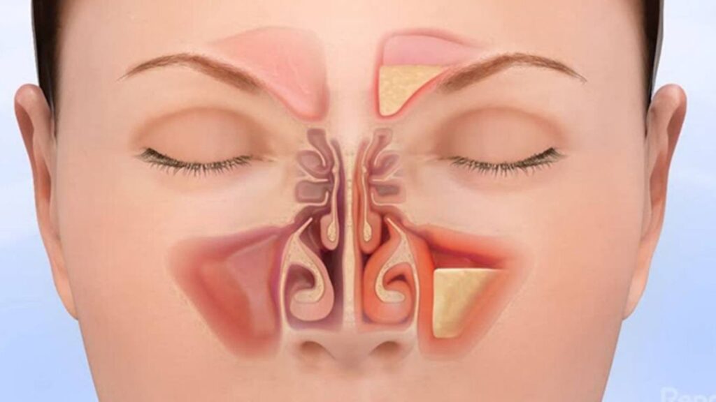 Sinusitis Unveiled: Causes, Symptoms, and Prevention