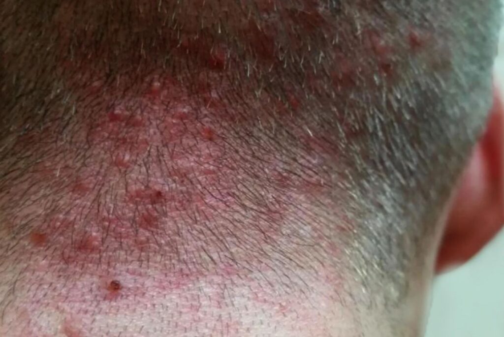 Understanding Folliculitis: Causes, Symptoms, and Risk Factors