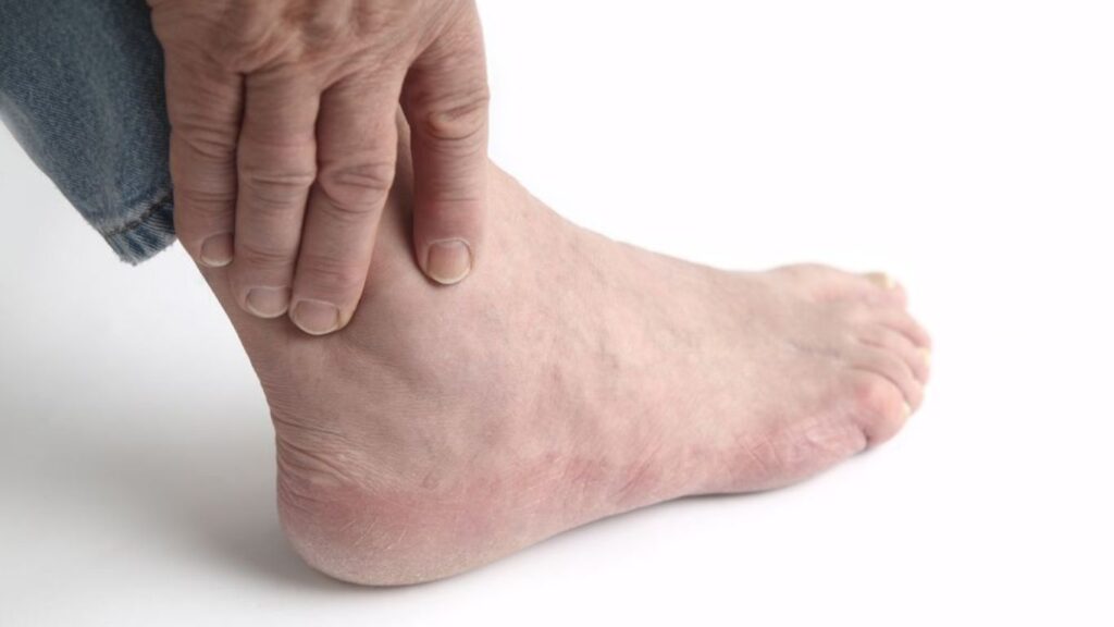 Uric Acid and Gout: How Are They Connected?