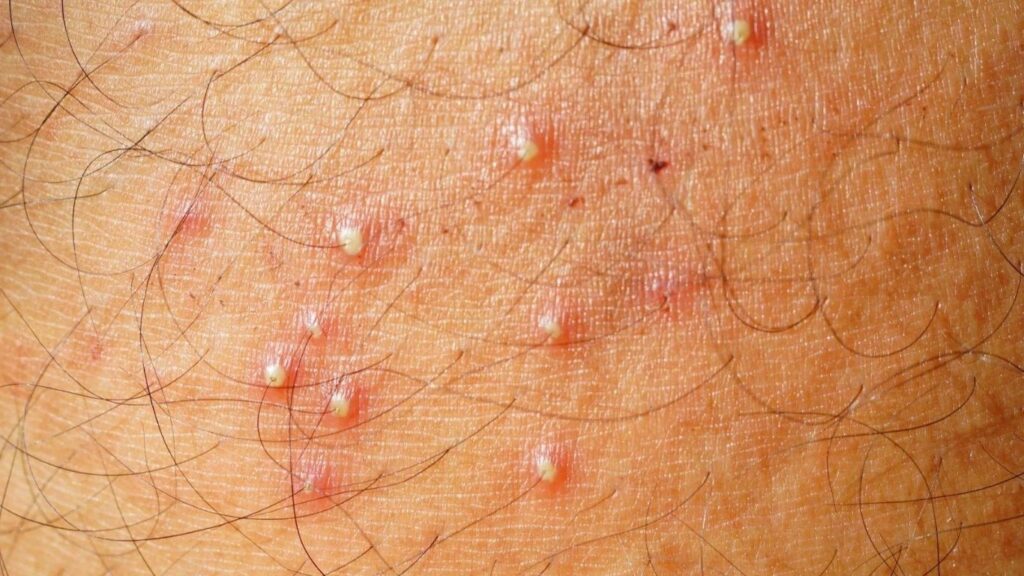 Understanding Folliculitis: Causes, Symptoms, and Risk Factors