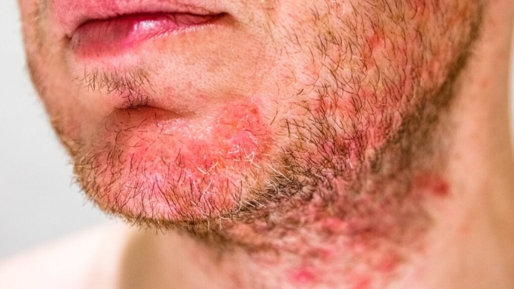 Understanding Folliculitis: Causes, Symptoms, and Risk Factors